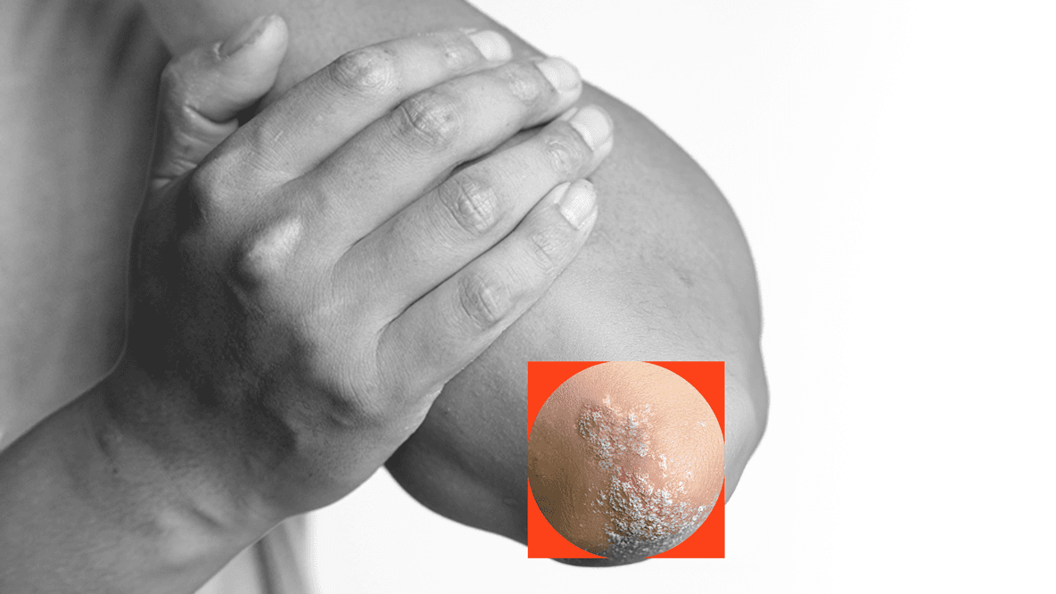 Traces of psoriasis on an elbow